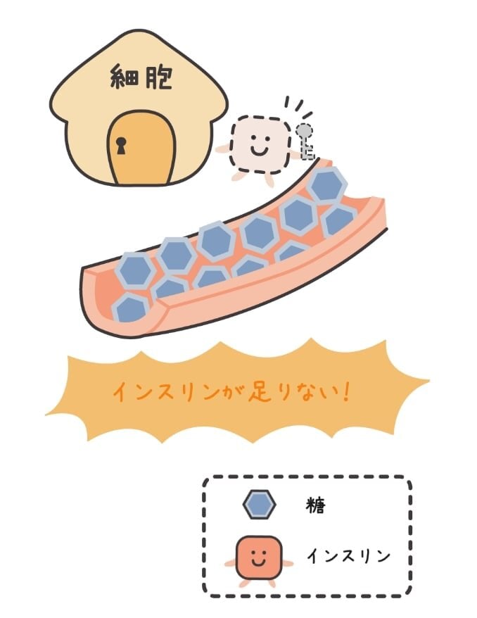 インスリンの分泌低下障害の説明図。「細胞」と書かれた家に鍵のついたドアがあり、インスリンのキャラクターが手に鍵を持っている。インスリンと鍵は分泌量が減っているため点線で表されている。インスリンが不足しているため、血管に細胞内に入れなくなった糖が溢れている。「インスリンが足りない！」