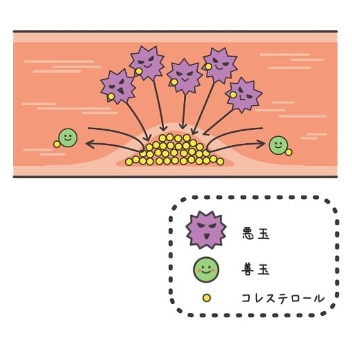 動脈硬化の進行のイメージ図。血管内の悪玉がコレステロールが蓄積し、善玉がコレステロールを取り除いている。善玉よりも悪玉が多いため、血管内にコレステロールが蓄積し血管が狭まっている。
