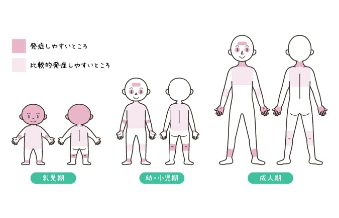 乳児期、幼・小児期、成人期のアトピー性皮膚炎の発症しやすい部位の図。
乳児期の発症しやすいところは耳と頭全体、手首の内側近辺、足首、膝の裏側。比較的発症しやすいところは首全体、腕を除いた体の前側、背中から腰まで。幼・小児期の発症しやすいところは、額、目の周り、肘の内側、手首、足首、膝の裏側。比較的発症しやすいところは腕を除いた体の前側、膝の表側。成人期の発症しやすいところは、額、目の周り、手、足首近辺。比較的発症しやすいところは胸、背中の上部、肘の内側、膝の裏側。