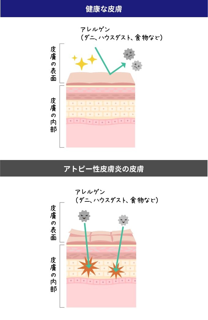 健康な皮膚とアトピー性皮膚炎の皮膚のイメージ図。皮膚は皮膚の表面と皮膚の内部に分かれている。健康な皮膚はバリア機能が働き、アレルゲン(ダニ、ハウスダスト、食物など)が内部に入り込むのを防いでいる。アトピー性皮膚炎の皮膚は、アレルゲン(ダニ、ハウスダスト、食物など)が皮膚の内部に入り込み刺激を受けている。
