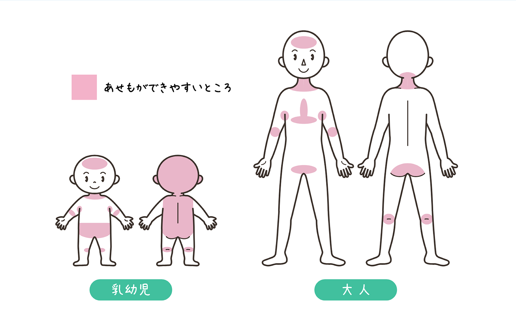 大人と乳幼児のあせもができやすいところの図。乳幼児は額、首の周り、脇の下、肘の内側、お腹まわり、膝の内股側と裏側、耳の後ろ、後頭部からおしりにかけて。大人は額、首周り、脇の下、肘の内側、胸の中央としたの部分、股間、おしりの下側、膝の裏側。