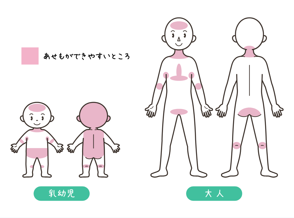 大人と乳幼児のあせもができやすいところの図。乳幼児は額、首の周り、脇の下、肘の内側、お腹まわり、膝の内股側と裏側、耳の後ろ、後頭部からおしりにかけて。大人は額、首周り、脇の下、肘の内側、胸の中央としたの部分、股間、おしりの下側、膝の裏側。