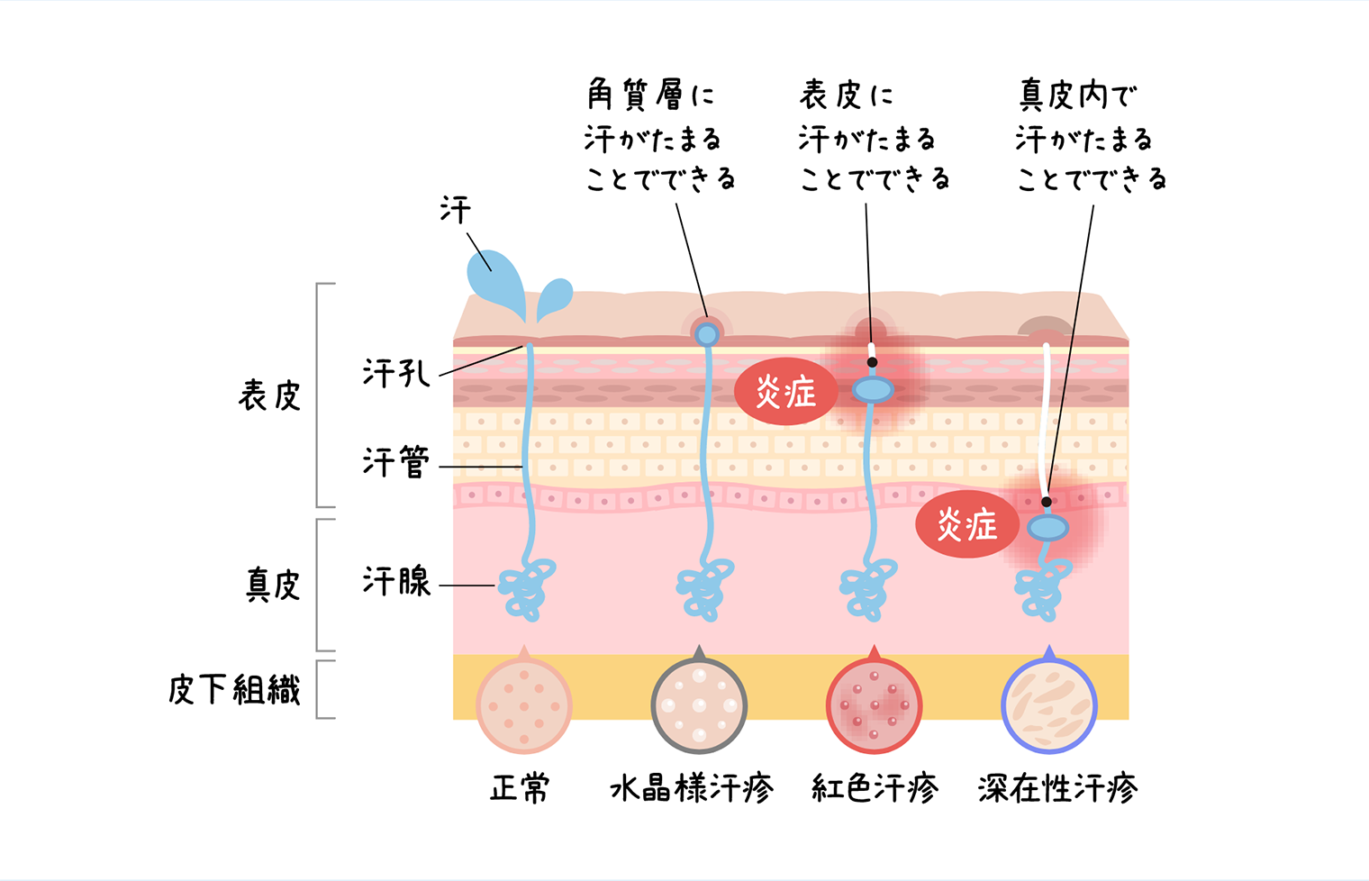 あせもの種類を示した図。表皮から皮下組織までの断面の図があり、体の外側から「表皮」「真皮」「皮下組織」に分かれている。正常な状態では、真皮にある汗腺から表皮中にある汗管を通って汗孔から表皮の表面に汗が分泌される。水晶様汗疹は角質層に汗がたまることでできる。紅色汗疹は表皮に汗がたまることでできる。深在性汗疹は真皮内で汗がたまることでできる。水晶様汗疹は紅色汗疹は表皮に汗がたまることでできる。深在性汗疹は真皮内で汗がたまることでできる。