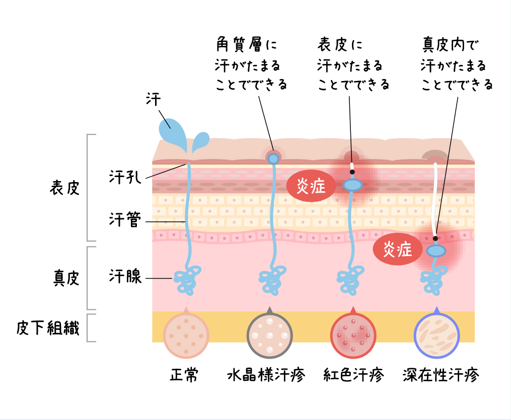 側から「表皮」「真皮」「皮下組織」に分かれている。正常な状態では、真皮にある汗腺から表皮中にある汗管を通って汗孔から表皮の表面に汗が分泌される。水晶様汗疹は角質層に汗がたまることでできる。紅色汗疹は表皮に汗がたまることでできる。深在性汗疹は真皮内で汗がたまることでできる。水晶様汗疹は紅色汗疹は表皮に汗がたまることでできる。深在性汗疹は真皮内で汗がたまることでできる。