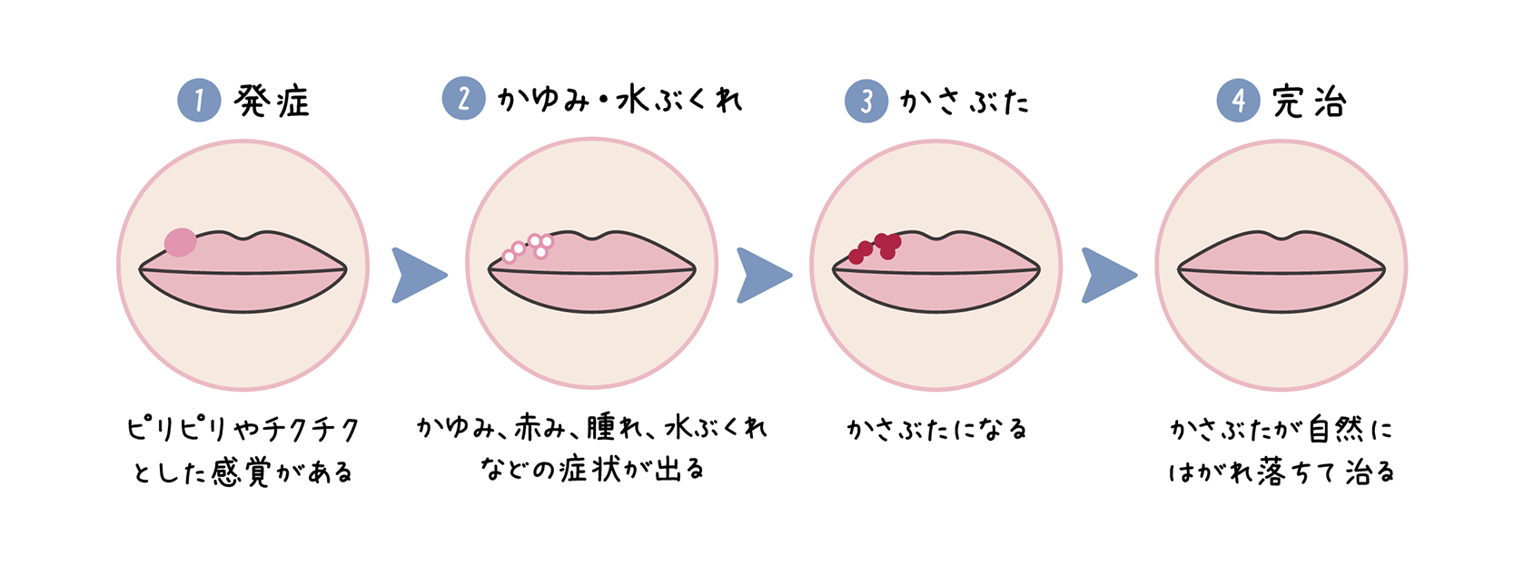 口唇ヘルペスの発症から完治までの症状の図。①発症 ピリピリやチクチクとした感覚がある ③かゆみ・水ぶくれ かゆみ、赤み、腫れ、水ぶくれなどの症状が出る ③かさぶた かさぶたになる ④完治 かさぶたが自然にはがれ落ちて治る。
