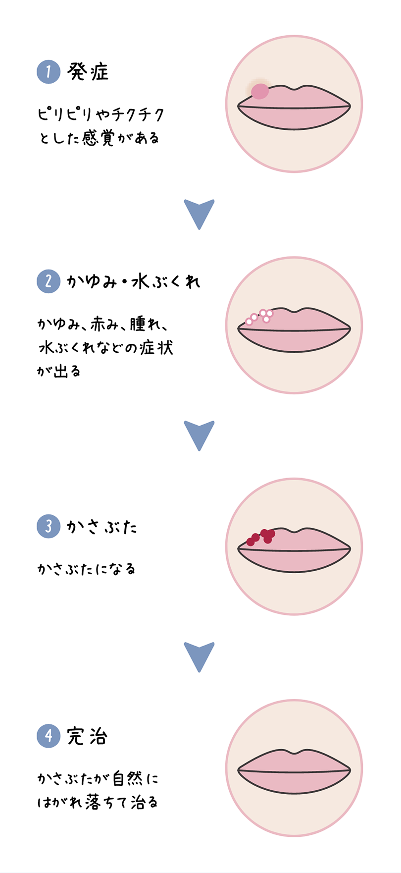 口唇ヘルペスの発症から完治までの症状の図。①発症 ピリピリやチクチクとした感覚がある ③かゆみ・水ぶくれ かゆみ、赤み、腫れ、水ぶくれなどの症状が出る ③かさぶた かさぶたになる ④完治 かさぶたが自然にはがれ落ちて治る。
