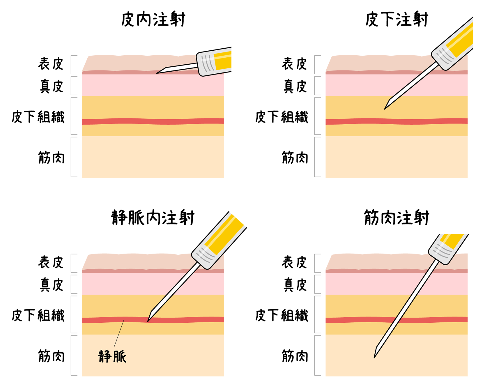 注射の投与経路別の分類図。図中の体内は体の外から順に「表皮」「真皮」「皮下組織」「筋肉」に分かれており、注射器で注射剤の投与位置が示されている。「皮内注射」は表皮と真皮の間に投与。「皮下注射」は皮下組織に投与。「静脈内注射」は皮下組織内の静脈に投与。「筋肉注射」は筋肉内に投与。