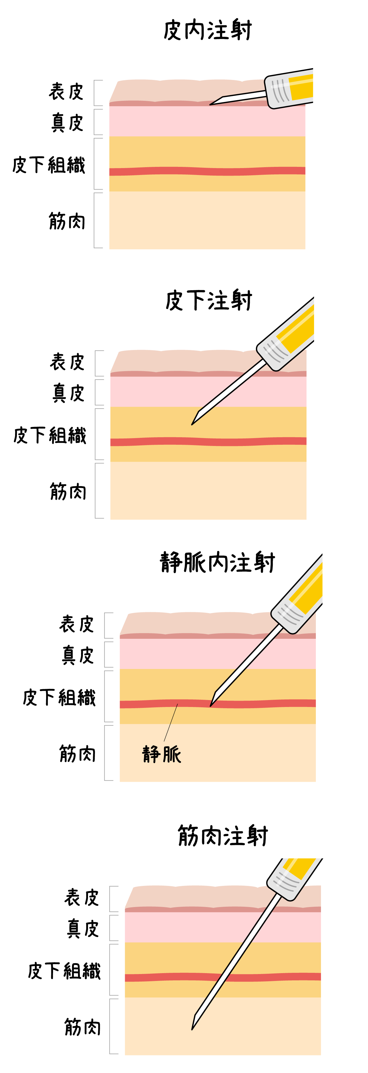 注射の投与経路別の分類図。図中の体内は体の外から順に「表皮」「真皮」「皮下組織」「筋肉」に分かれており、注射器で注射剤の投与位置が示されている。「皮内注射」は表皮と真皮の間に投与。「皮下注射」は皮下組織に投与。「静脈内注射」は皮下組織内の静脈に投与。「筋肉注射」は筋肉内に投与。